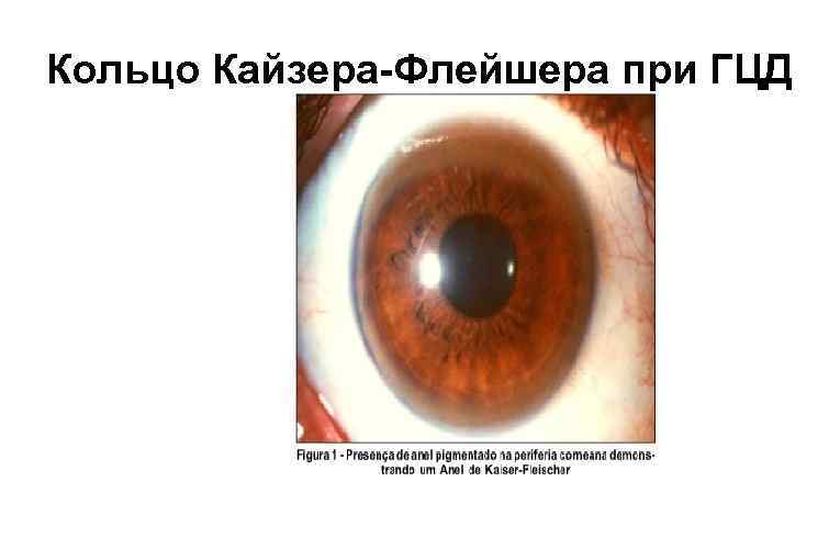 Кольцо Кайзера-Флейшера при ГЦД 
