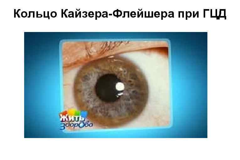 Кольцо Кайзера-Флейшера при ГЦД 