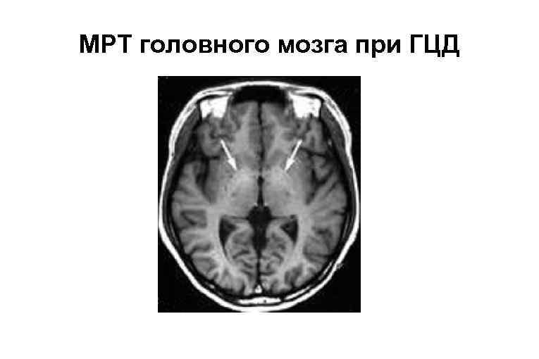 МРТ головного мозга при ГЦД 