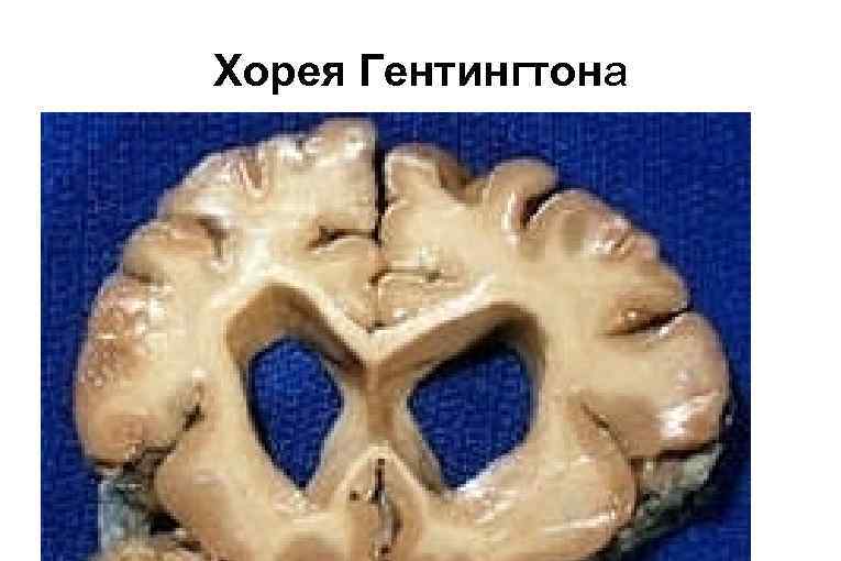 Хорея Гентингтона 