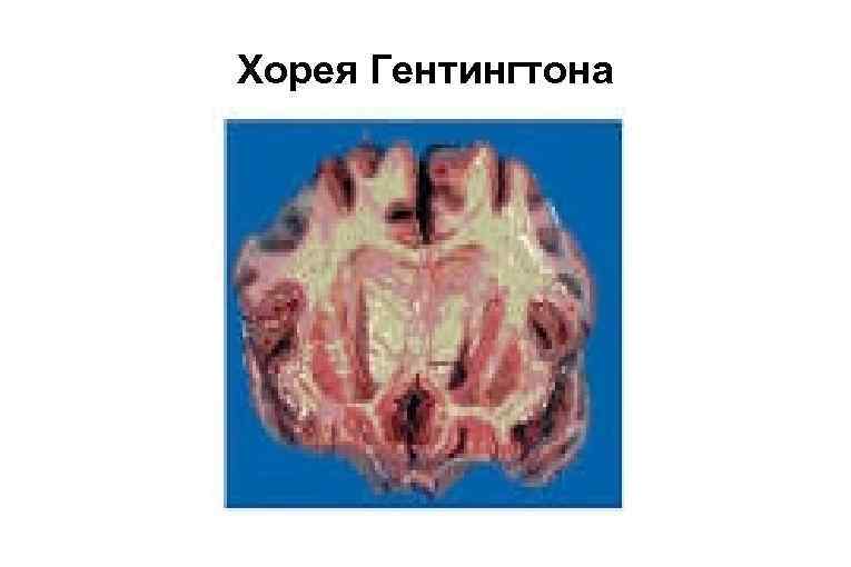 Хорея Гентингтона 