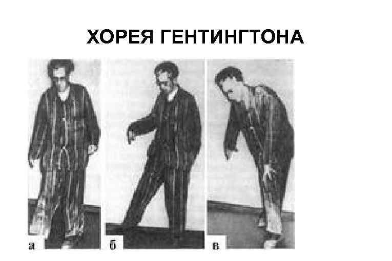 ХОРЕЯ ГЕНТИНГТОНА 