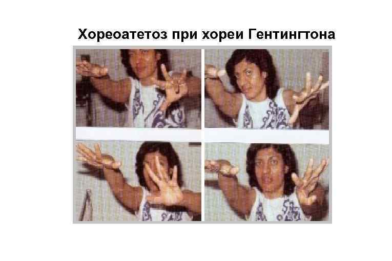 Хореоатетоз при хореи Гентингтона 