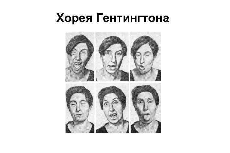 Хорея Гентингтона 