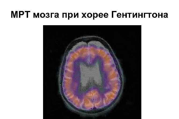 МРТ мозга при хорее Гентингтона 