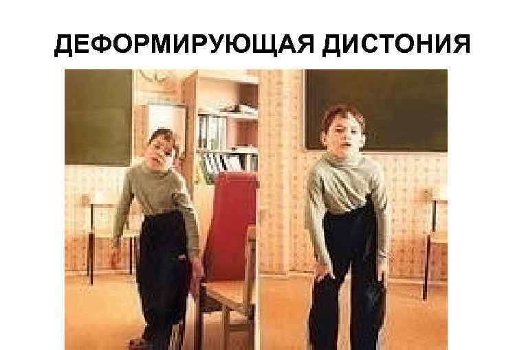 ДЕФОРМИРУЮЩАЯ ДИСТОНИЯ 