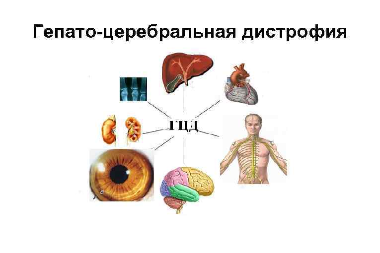 Гепато-церебральная дистрофия 