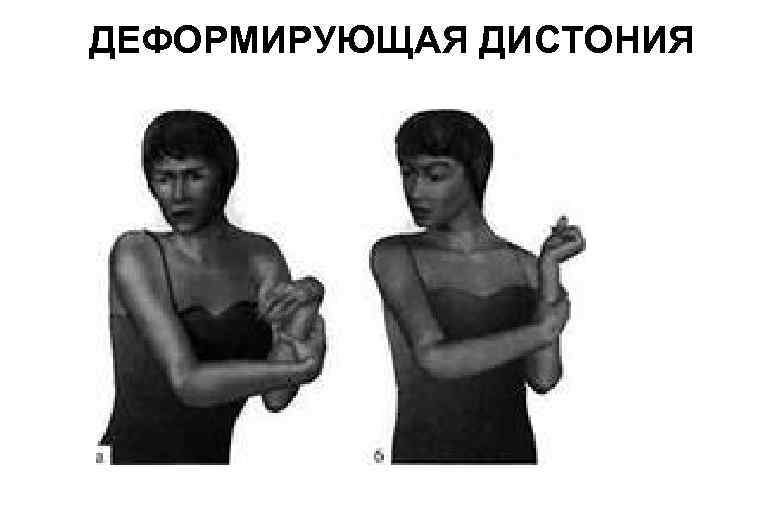 ДЕФОРМИРУЮЩАЯ ДИСТОНИЯ 