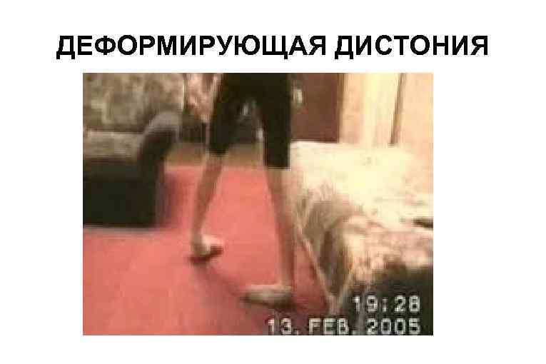 ДЕФОРМИРУЮЩАЯ ДИСТОНИЯ 