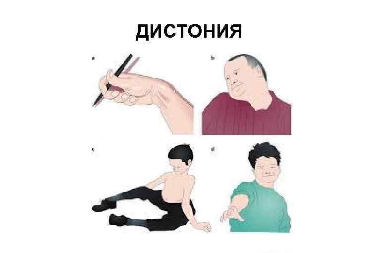 ДИСТОНИЯ 