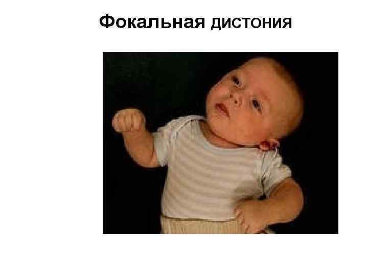 Фокальная ДИСТОНИЯ 