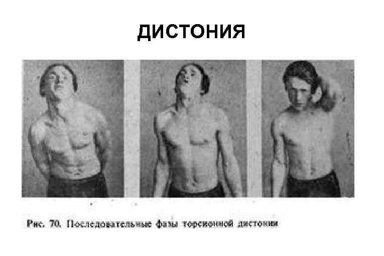 ДИСТОНИЯ 