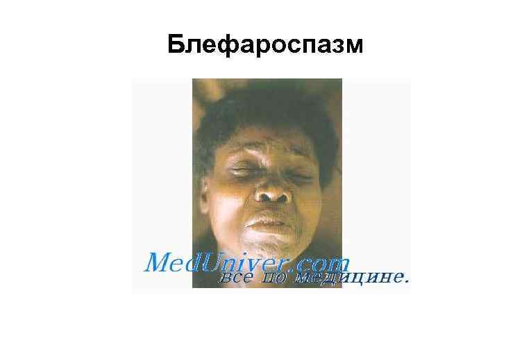 Блефароспазм 