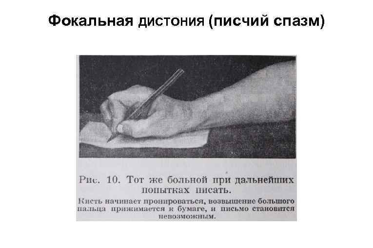 Фокальная ДИСТОНИЯ (писчий спазм) 