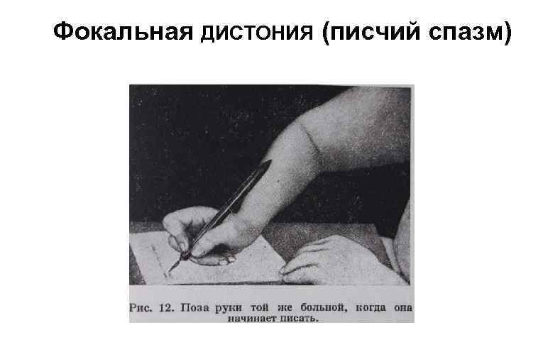 Фокальная ДИСТОНИЯ (писчий спазм) 