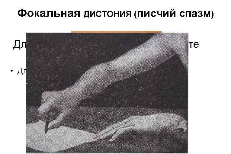 Фокальная ДИСТОНИЯ (писчий спазм) 
