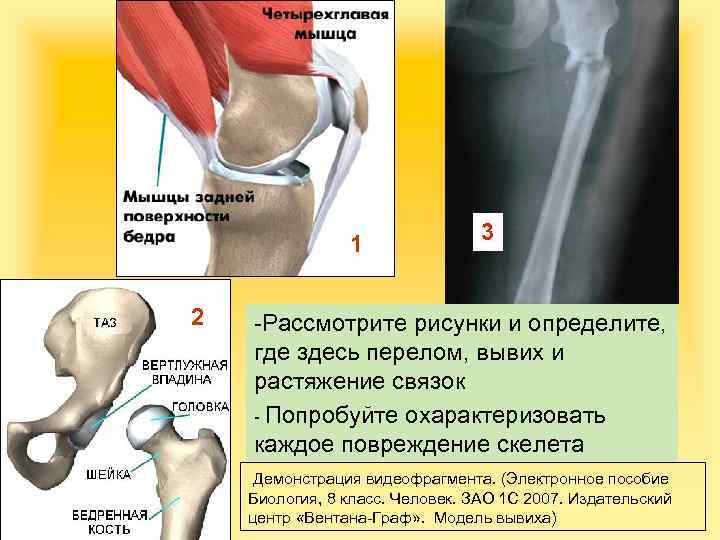 1 2 3 -Рассмотрите рисунки и определите, где здесь перелом, вывих и растяжение связок