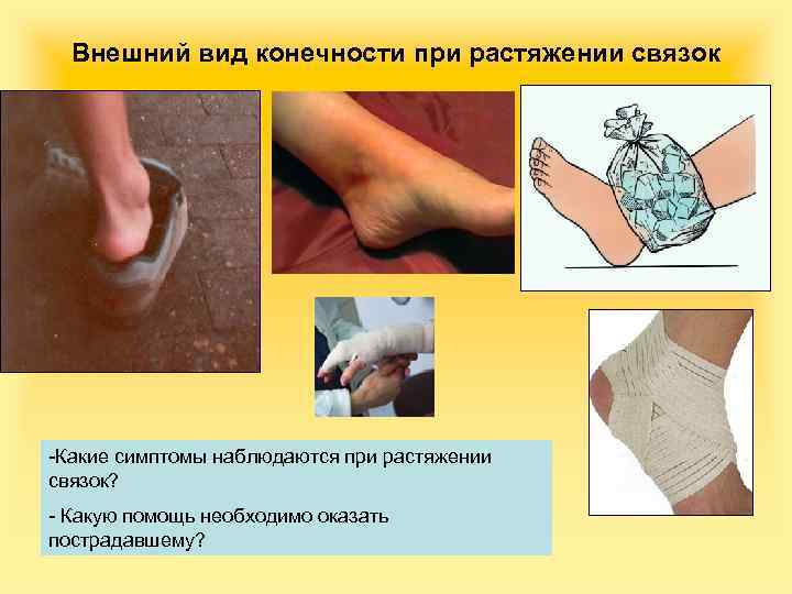 Внешний вид конечности при растяжении связок -Какие симптомы наблюдаются при растяжении связок? - Какую