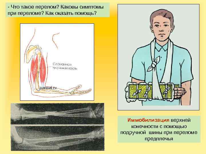 - Что такое перелом? Каковы симптомы при переломе? Как оказать помощь? Иммобилизация верхней конечности