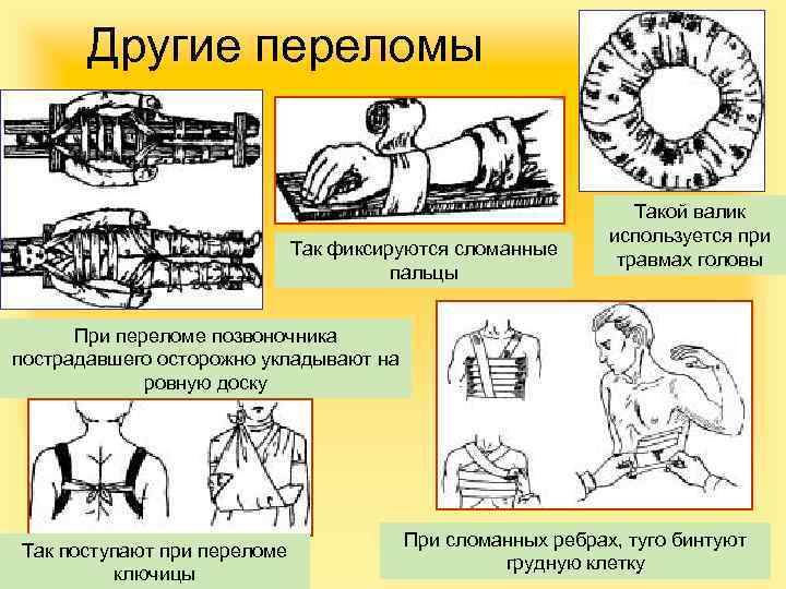 Другие переломы Так фиксируются сломанные пальцы Такой валик используется при травмах головы При переломе