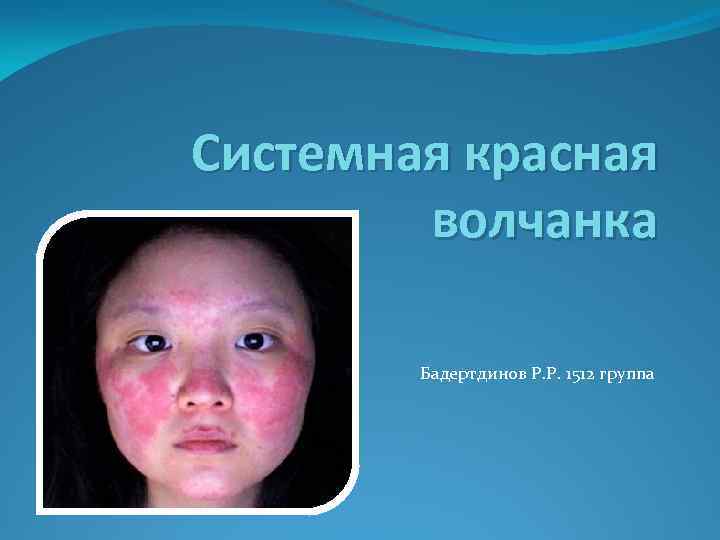 Системная красная волчанка Бадертдинов Р. Р. 1512 группа 