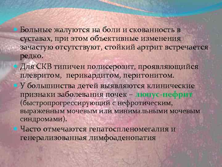  Больные жалуются на боли и скованность в суставах, при этом объективные изменения зачастую