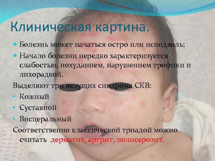 Клиническая картина. Болезнь может начаться остро или исподволь; Начало болезни нередко характеризуется слабостью, похуданием,