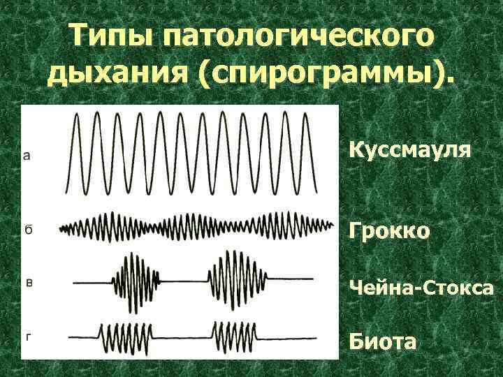 Назовите типы дыхания. Куссмауля Чейна Стокса Биота. Дыхание Биота Чейна Стокса Куссмауля. Ритмы Чейна-Стокса, Биота, Куссмауля. Типы дыхания Куссмауля Чейна Стокса Биота.