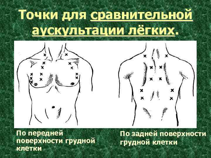 Аускультация грудной клетки пропедевтика. Аускультация лёгких точки выслушивания. Аускультация легких пропедевтика. Точки аускультации грудной клетки.