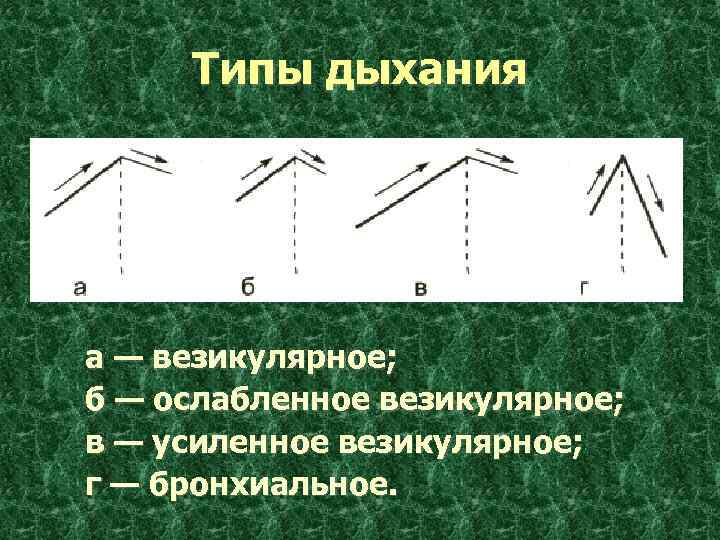 Типы дыхания а — везикулярное; б — ослабленное везикулярное; в — усиленное везикулярное; г