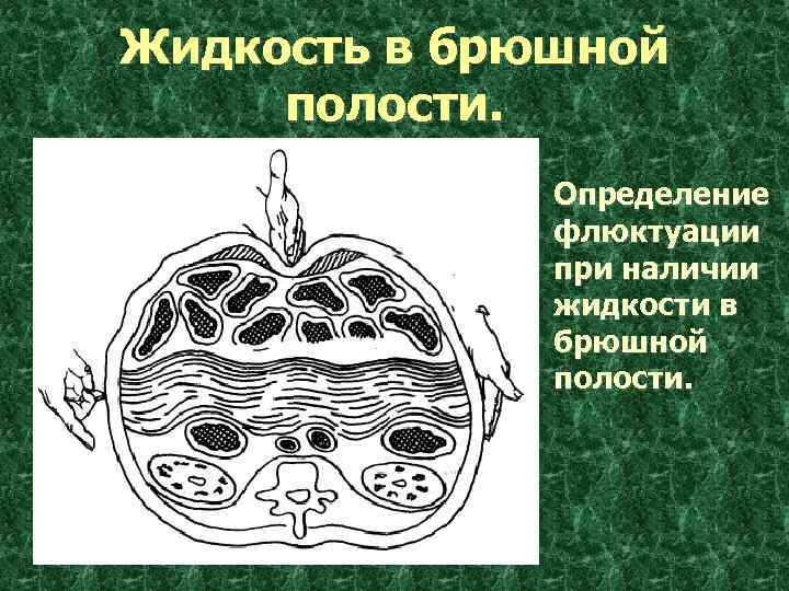 Жидкость в брюшной полости. Определение флюктуации при наличии жидкости в брюшной полости. 