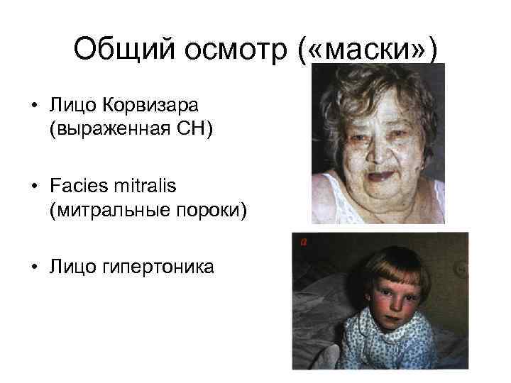 Общий осмотр ( «маски» ) • Лицо Корвизара (выраженная СН) • Facies mitralis (митральные