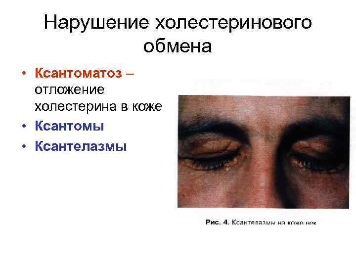 Нарушение холестеринового обмена • Ксантоматоз – отложение холестерина в коже • Ксантомы • Ксантелазмы
