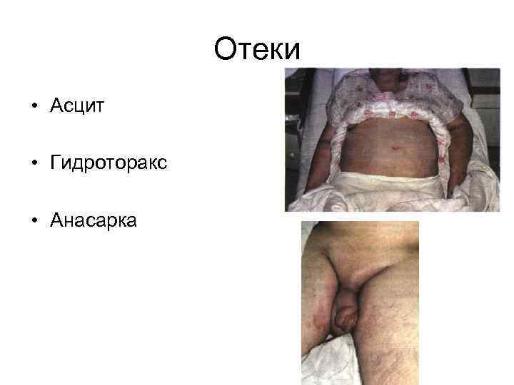 Отеки • Асцит • Гидроторакс • Анасарка 