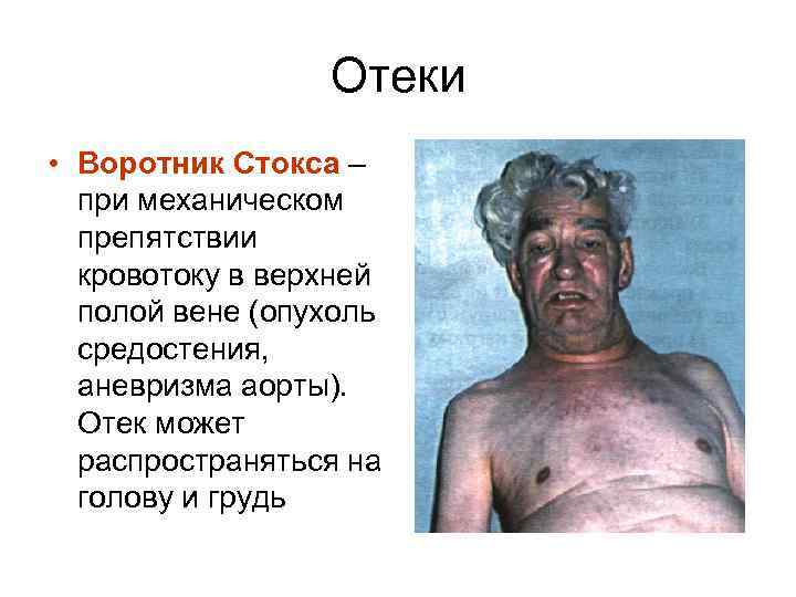 Отеки • Воротник Стокса – при механическом препятствии кровотоку в верхней полой вене (опухоль