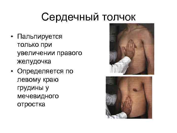 Сердечный толчок • Пальпируется только при увеличении правого желудочка • Определяется по левому краю