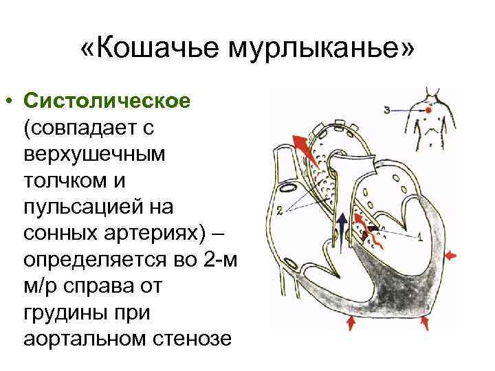  «Кошачье мурлыканье» • Систолическое (совпадает с верхушечным толчком и пульсацией на сонных артериях)