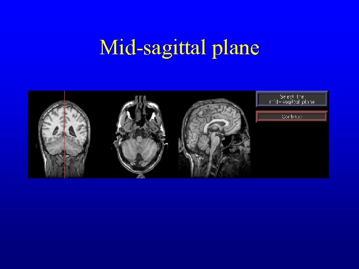 Mid-sagittal plane 
