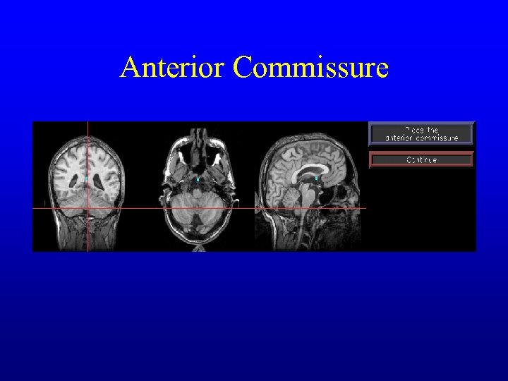 Anterior Commissure 