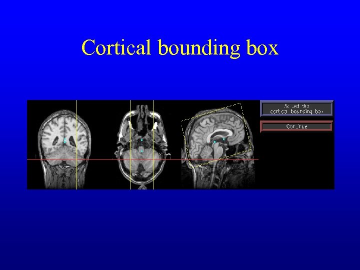 Cortical bounding box 
