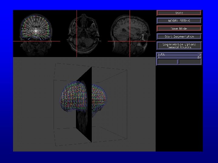 Propagation from one radial 