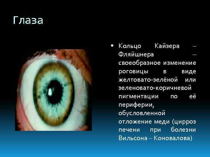 Глаза Кольцо Кайзера – Фляйшнера – своеобразное изменение роговицы в виде желтовато-зелёной или зеленовато-коричневой