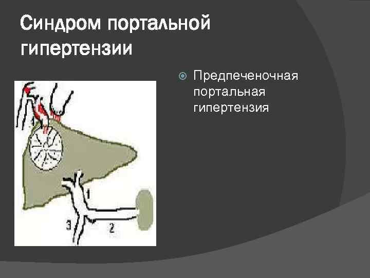 Синдром портальной гипертензии Предпеченочная портальная гипертензия 