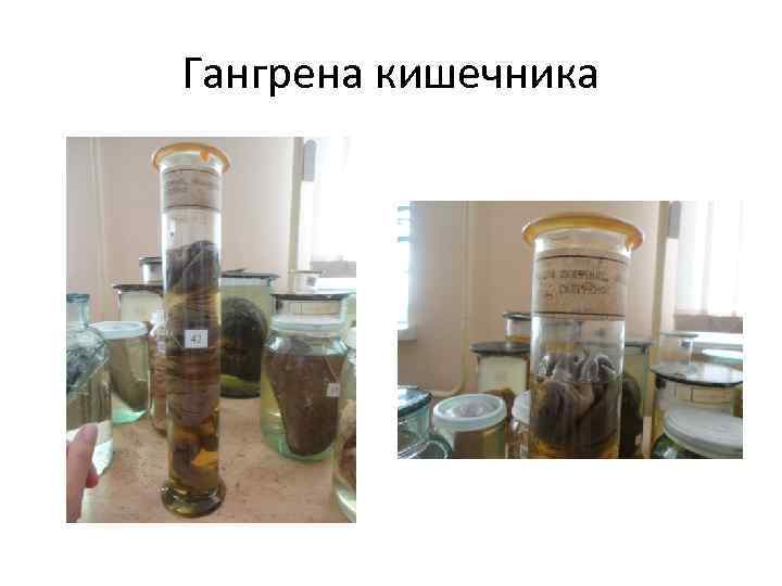 Гангрена кишечника 