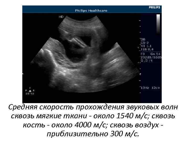 Средняя скорость прохождения звуковых волн сквозь мягкие ткани - около 1540 м/с; сквозь кость