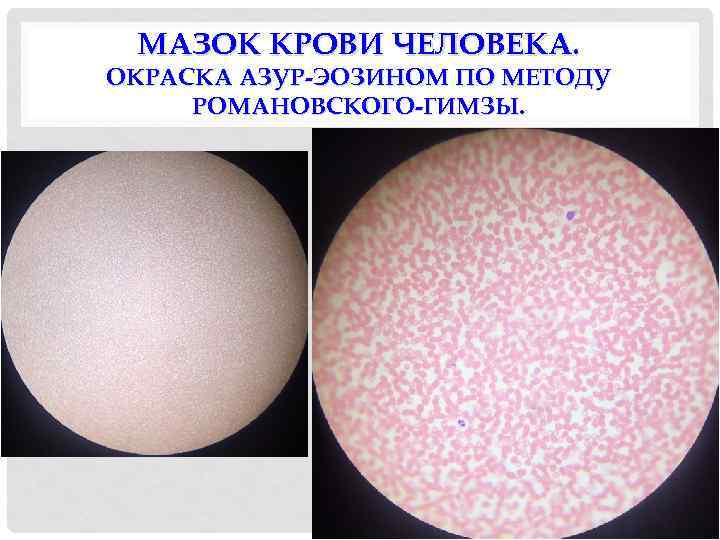 МАЗОК КРОВИ ЧЕЛОВЕКА. ОКРАСКА АЗУР-ЭОЗИНОМ ПО МЕТОДУ РОМАНОВСКОГО-ГИМЗЫ. 
