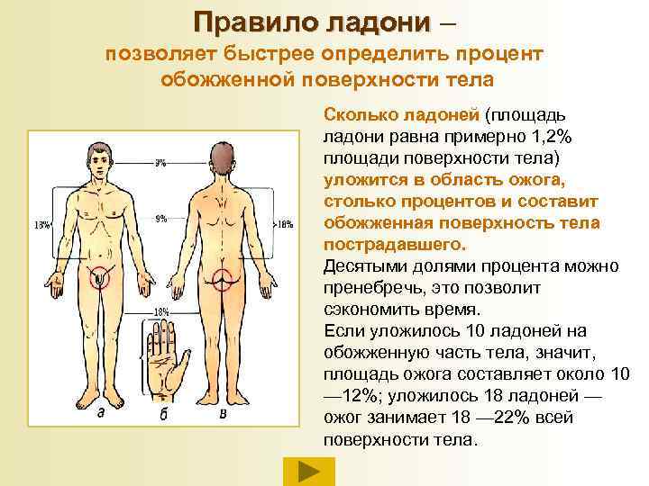 Правило ладони – позволяет быстрее определить процент обожженной поверхности тела Сколько ладоней (площадь ладони