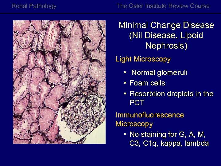 Renal Pathology The Osler Institute Review Course Minimal Change Disease (Nil Disease, Lipoid Nephrosis)