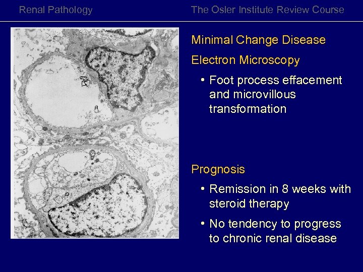 Renal Pathology The Osler Institute Review Course Minimal Change Disease Electron Microscopy • Foot