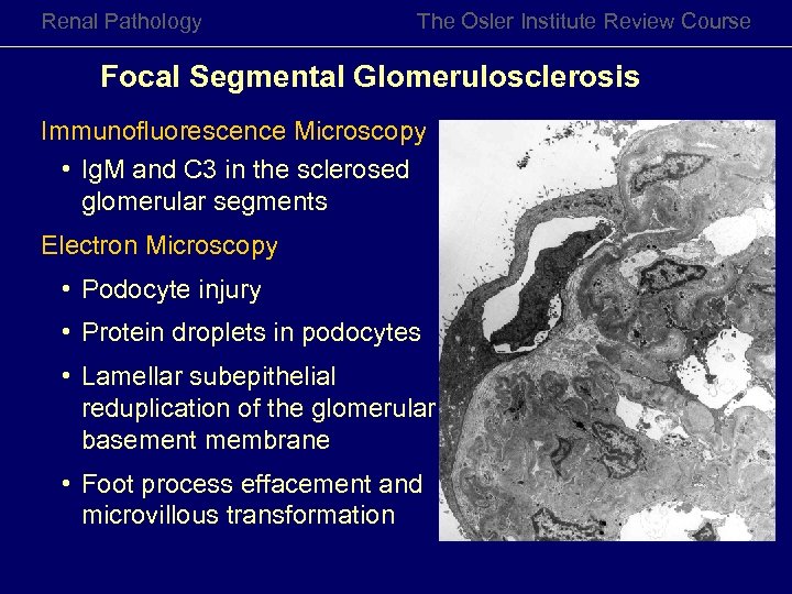 Renal Pathology The Osler Institute Review Course Focal Segmental Glomerulosclerosis Immunofluorescence Microscopy • Ig.